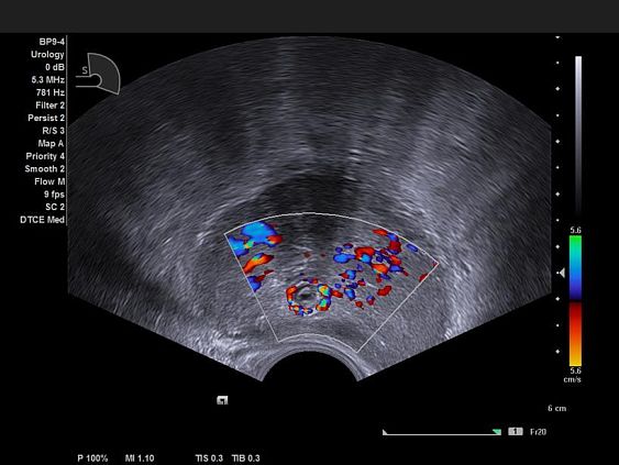 Siemens Acuson NX3 аппарат УЗИ