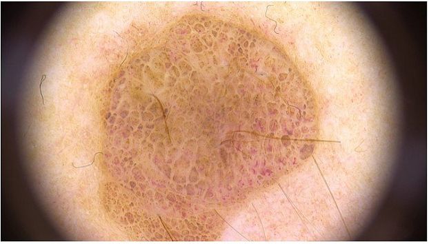 Клинические изображения Аппарат для цифровой дерматоскопии FotoFinder medicam 1000 с док-станцией