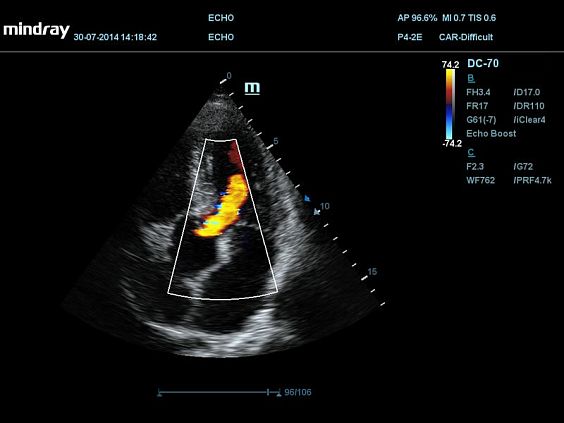 УЗИ аппарат Mindray DC-70 Pro X-insight