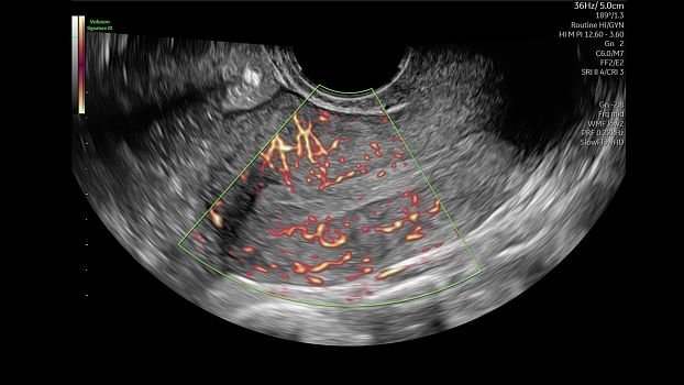 Клинические изображения GE HealthCare Voluson Signature 20 УЗИ аппарат