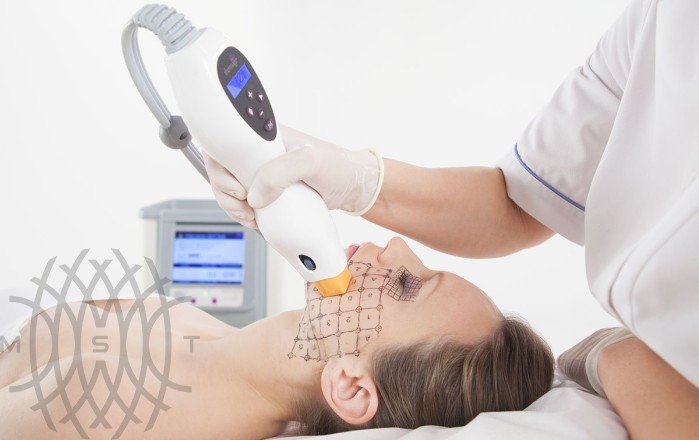 Монополярный RF-аппарат Solta Medical Inc. Thermage